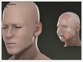 FULL-FACE-TRANSPLANT-Francisco Pacavira